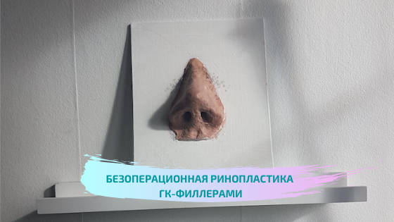 Безоперационная ринопластика ГК-филлерами